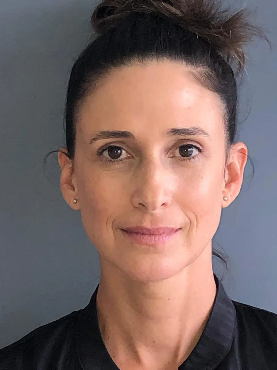 Blepharoplasty (Eyelid Surgery) — after