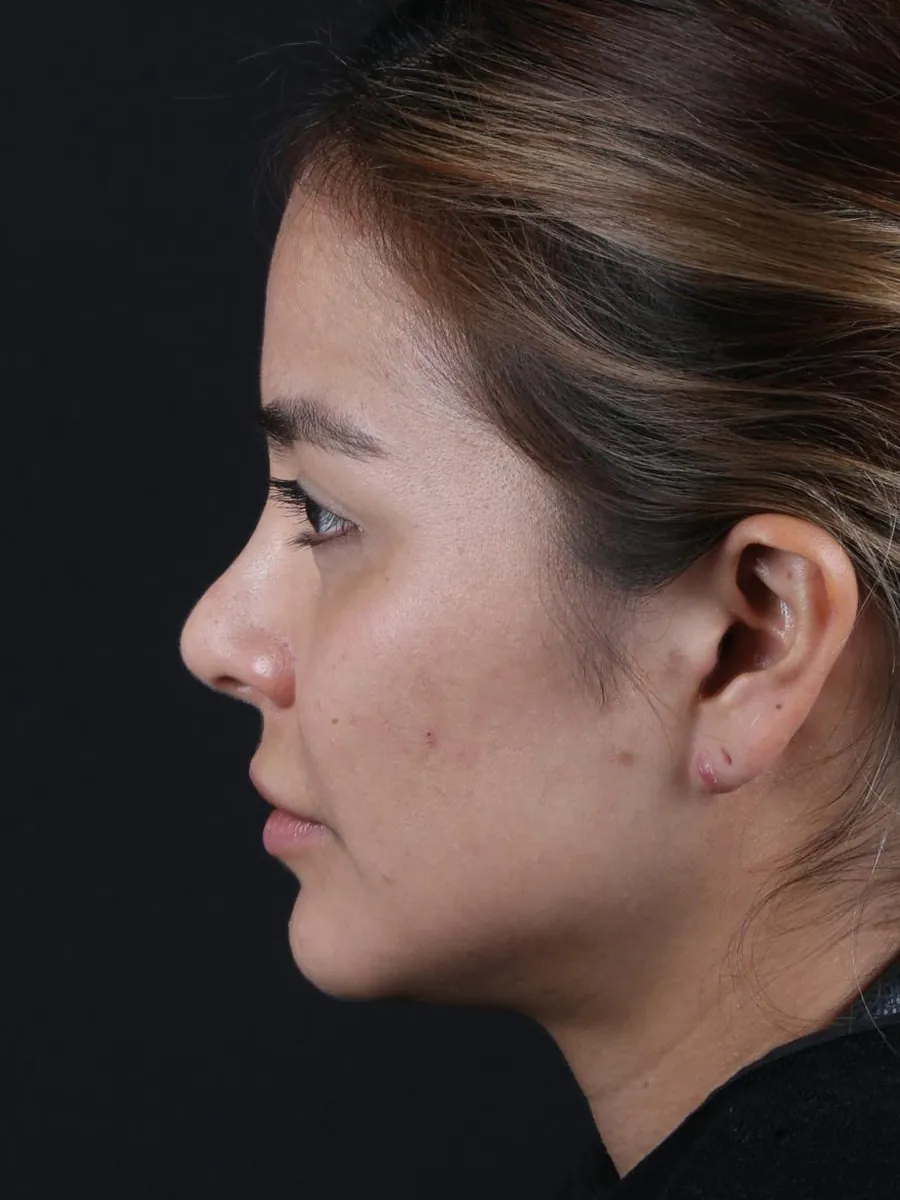 Revision Rhinoplasty — Profile — before