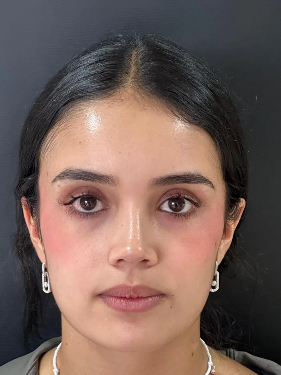 Rhinoplasty — after