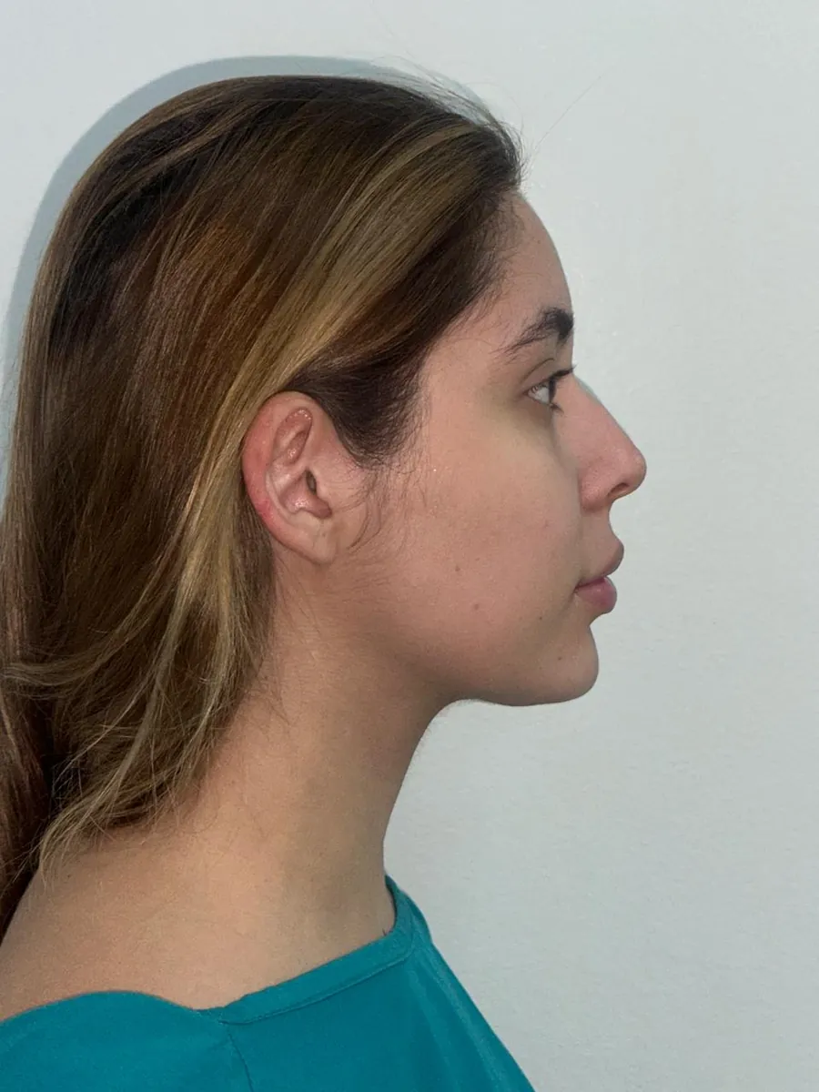 Rhinoplasty — Profile — before