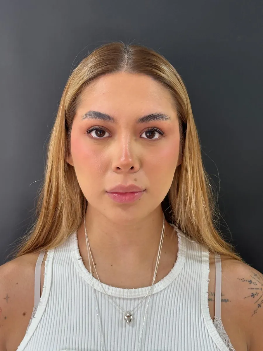 Rhinoplasty — after