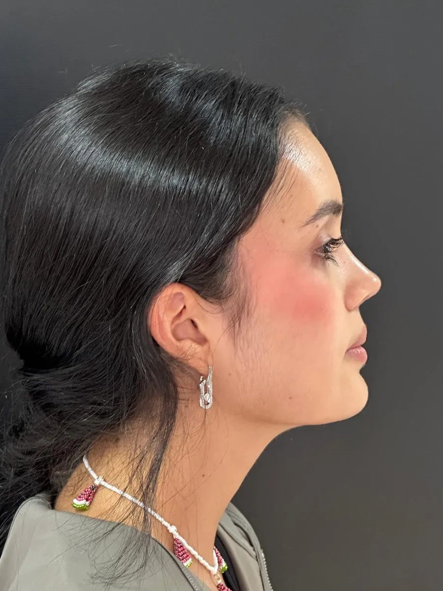 Rhinoplasty — Profile — after