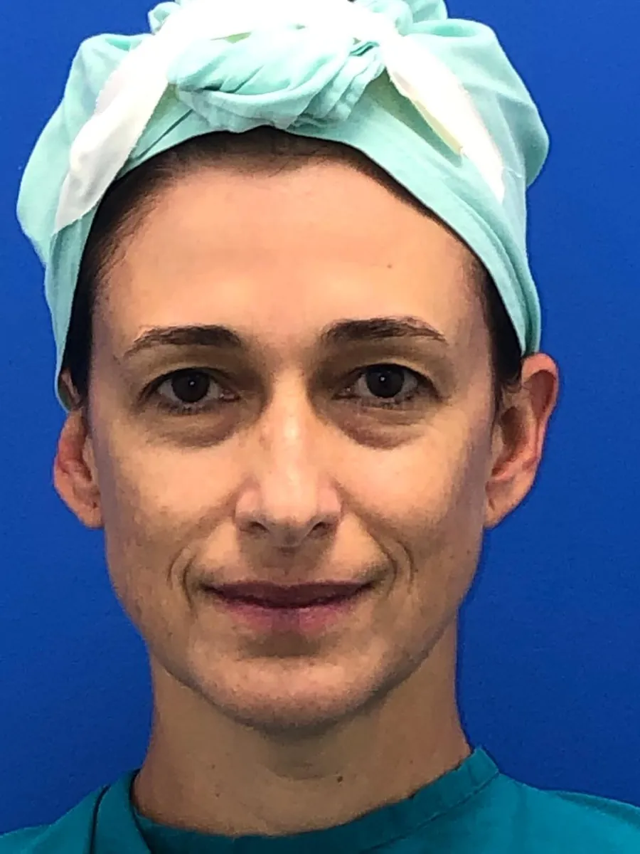 Blepharoplasty (Eyelid Surgery) — before