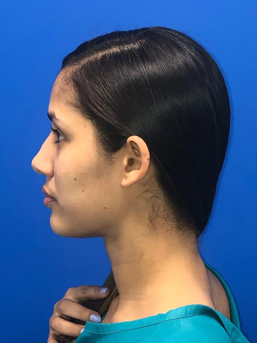 Otoplasty — Profile — before