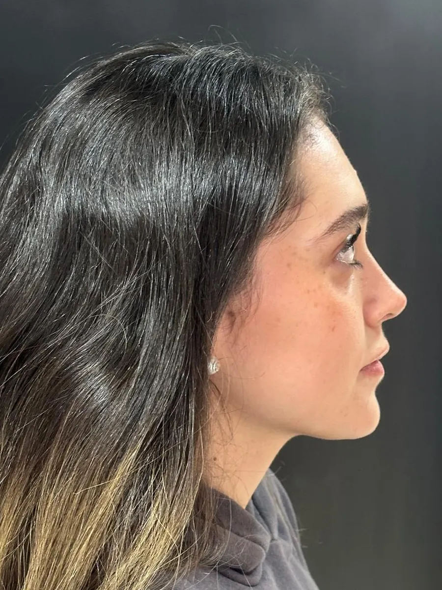 Rhinoplasty — Profile — after