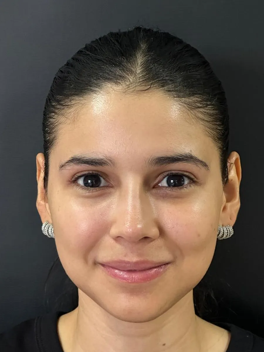 Rhinoplasty — after