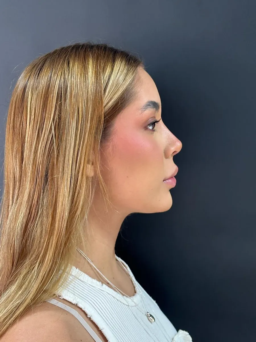 Rhinoplasty — Profile — after