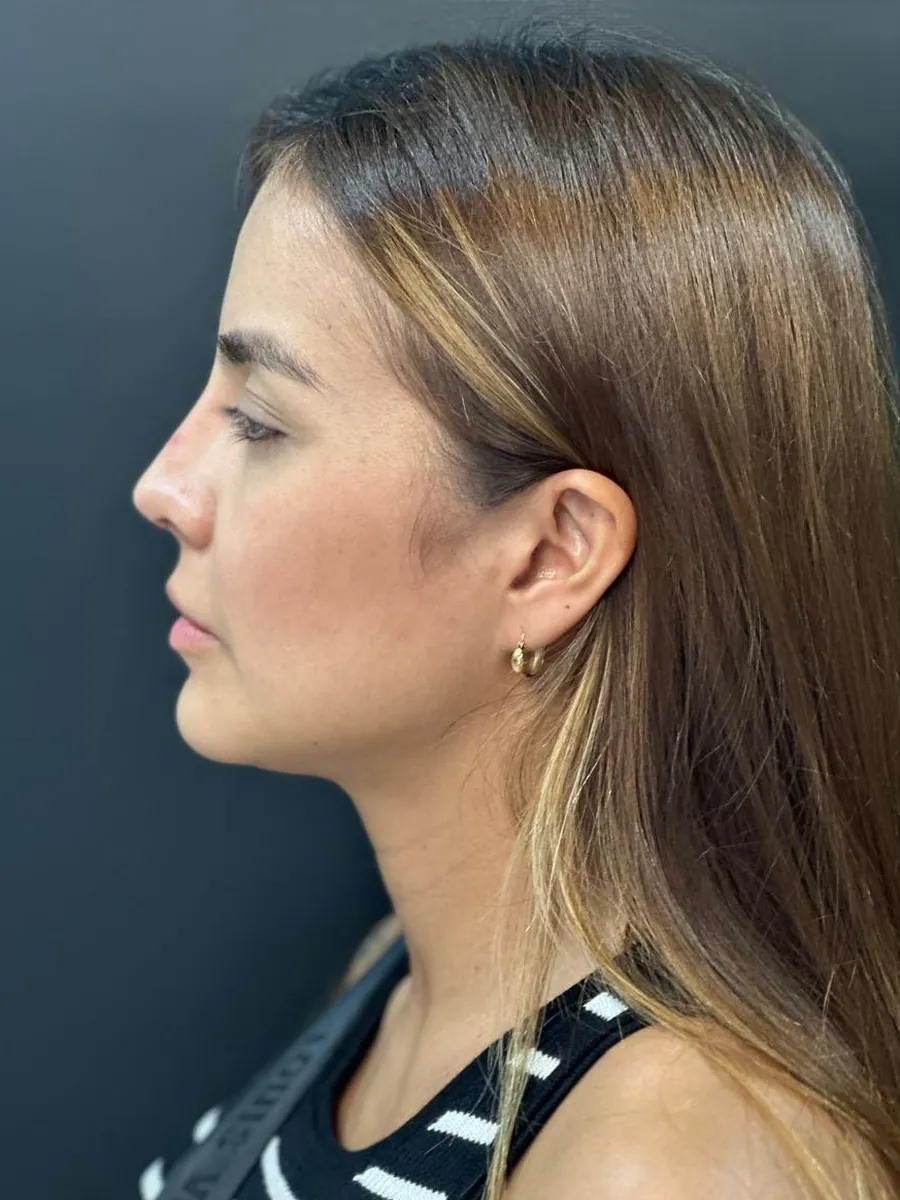 Revision Rhinoplasty — Profile — after