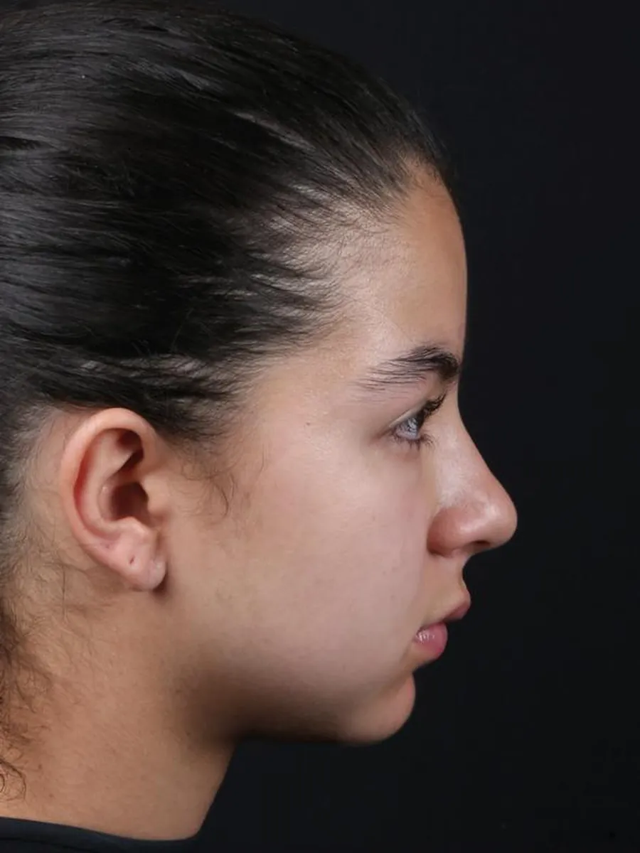 Rhinoplasty — Profile — before