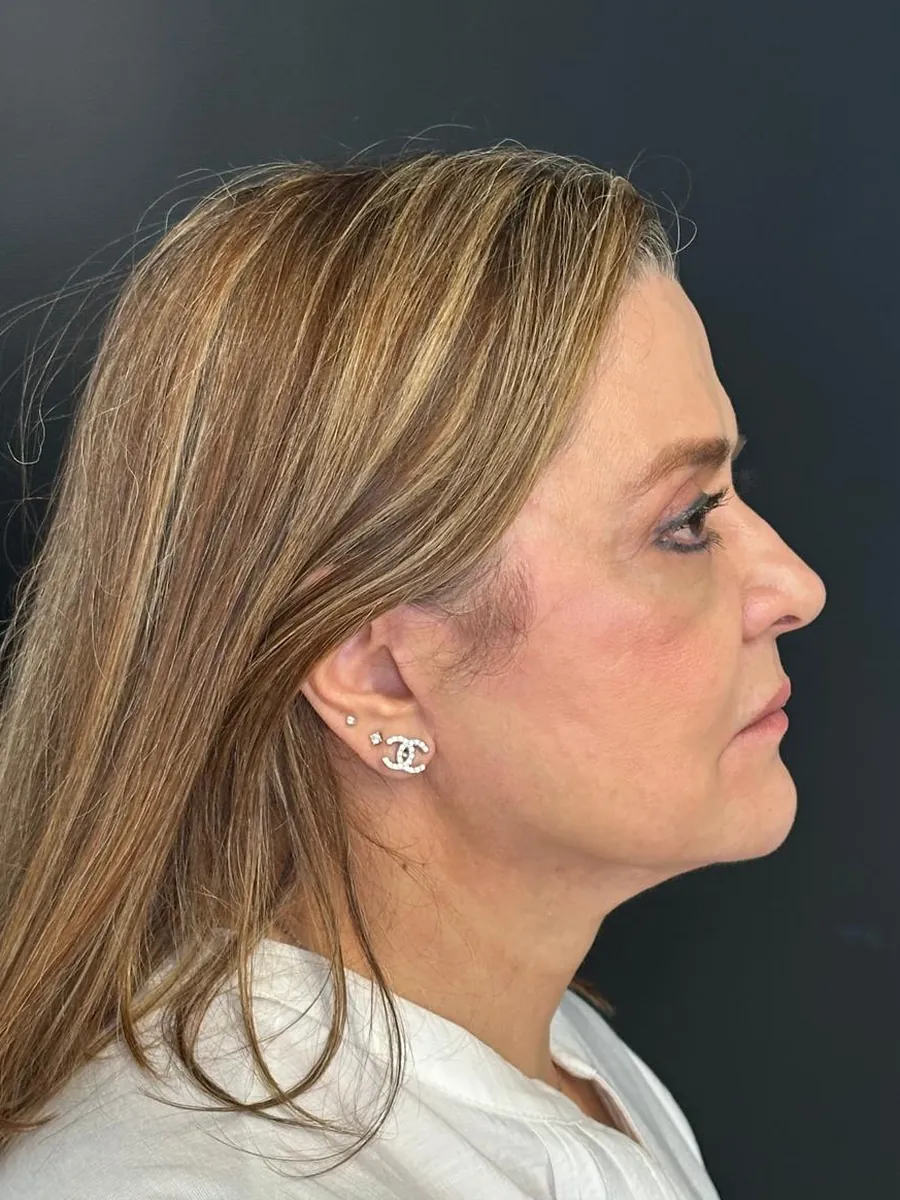 Facelift — Profile — after