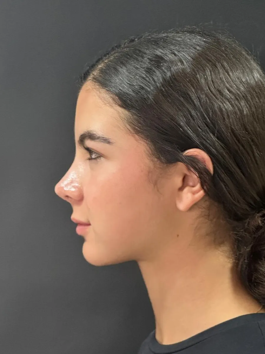 Rhinoplasty — Profile — after