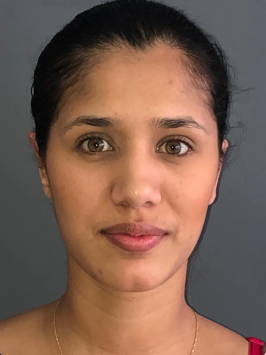 Otoplasty (Ear Surgery) — after