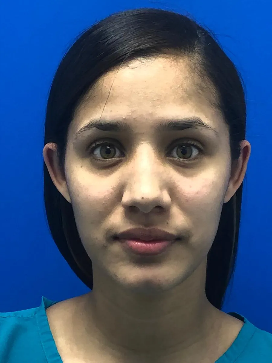 Otoplasty (Ear Surgery) — before