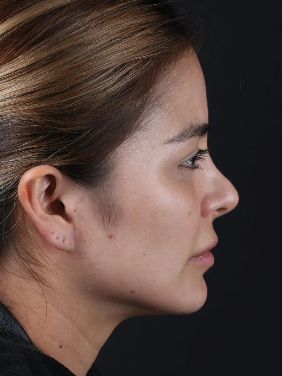 Revision Rhinoplasty — Profile — before