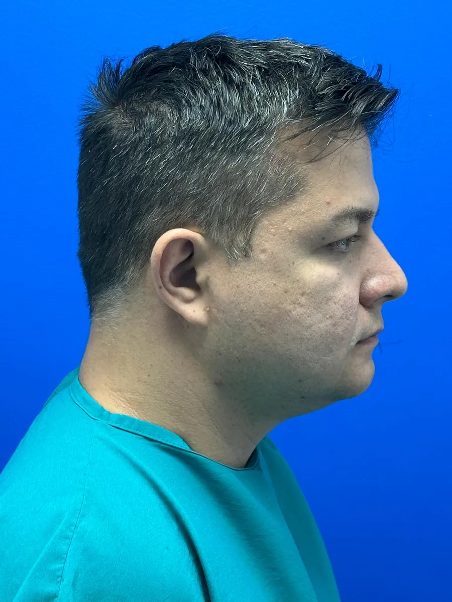 Facial & Neck Liposuction — Profile — before