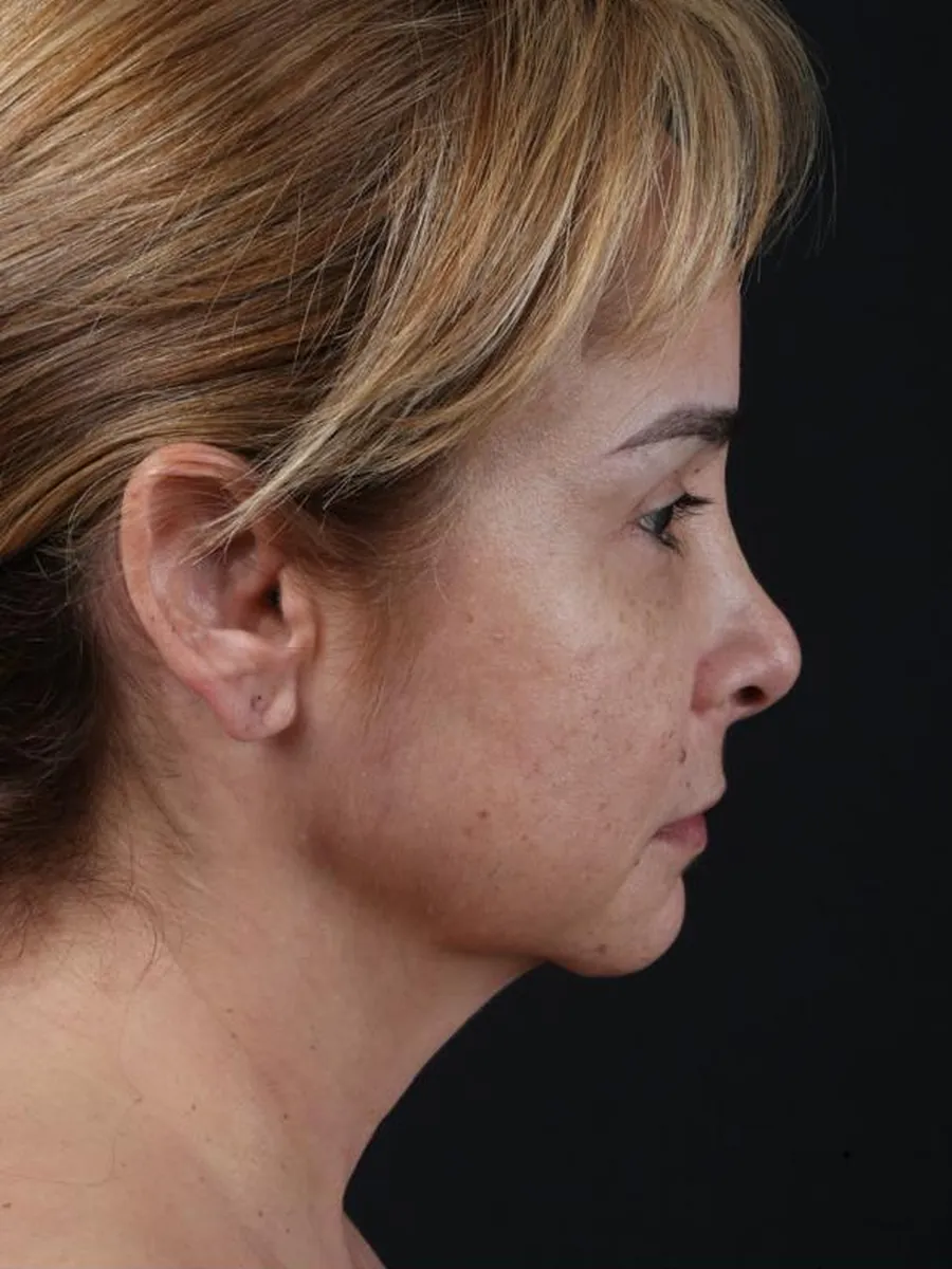 Facelift — Profile — before