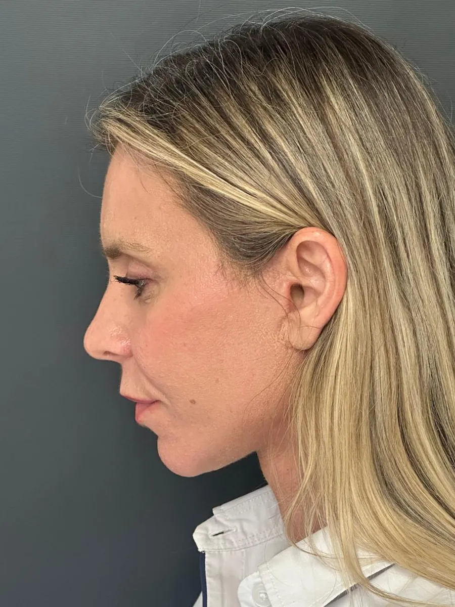 Facelift — Profile — after