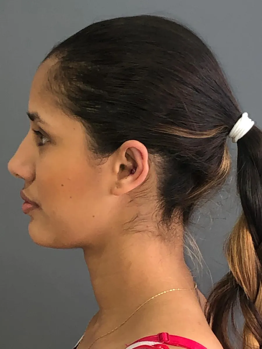 Otoplasty — Profile — after