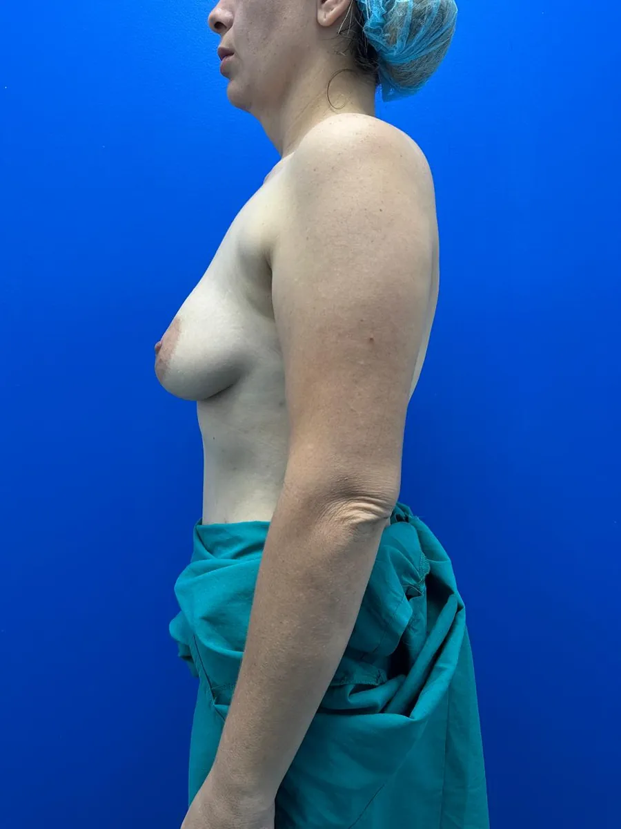 Breast Lift with Implants — Profile — before
