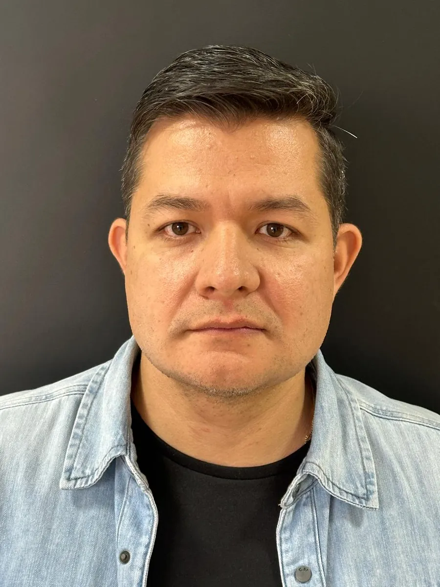 Facial & Neck Liposuction — after