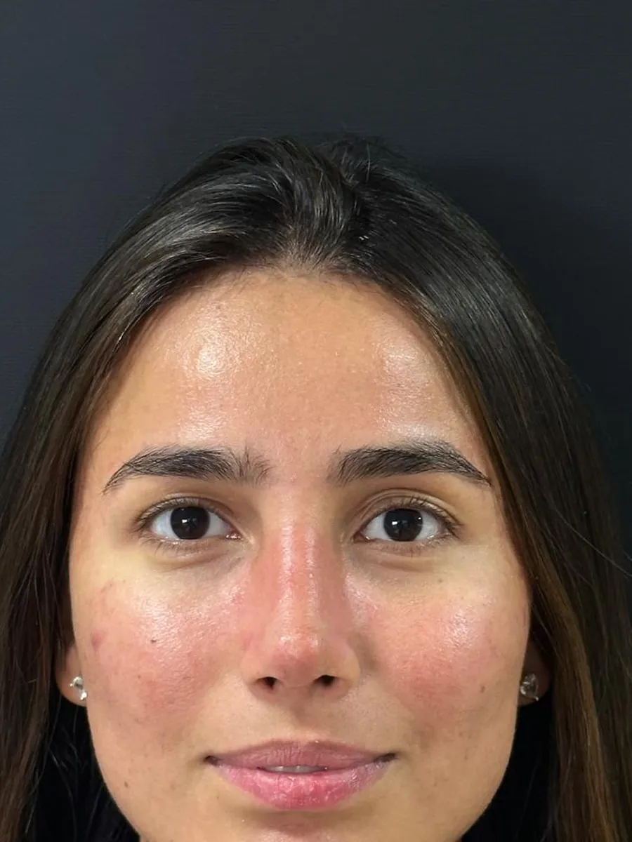 Rhinoplasty — after