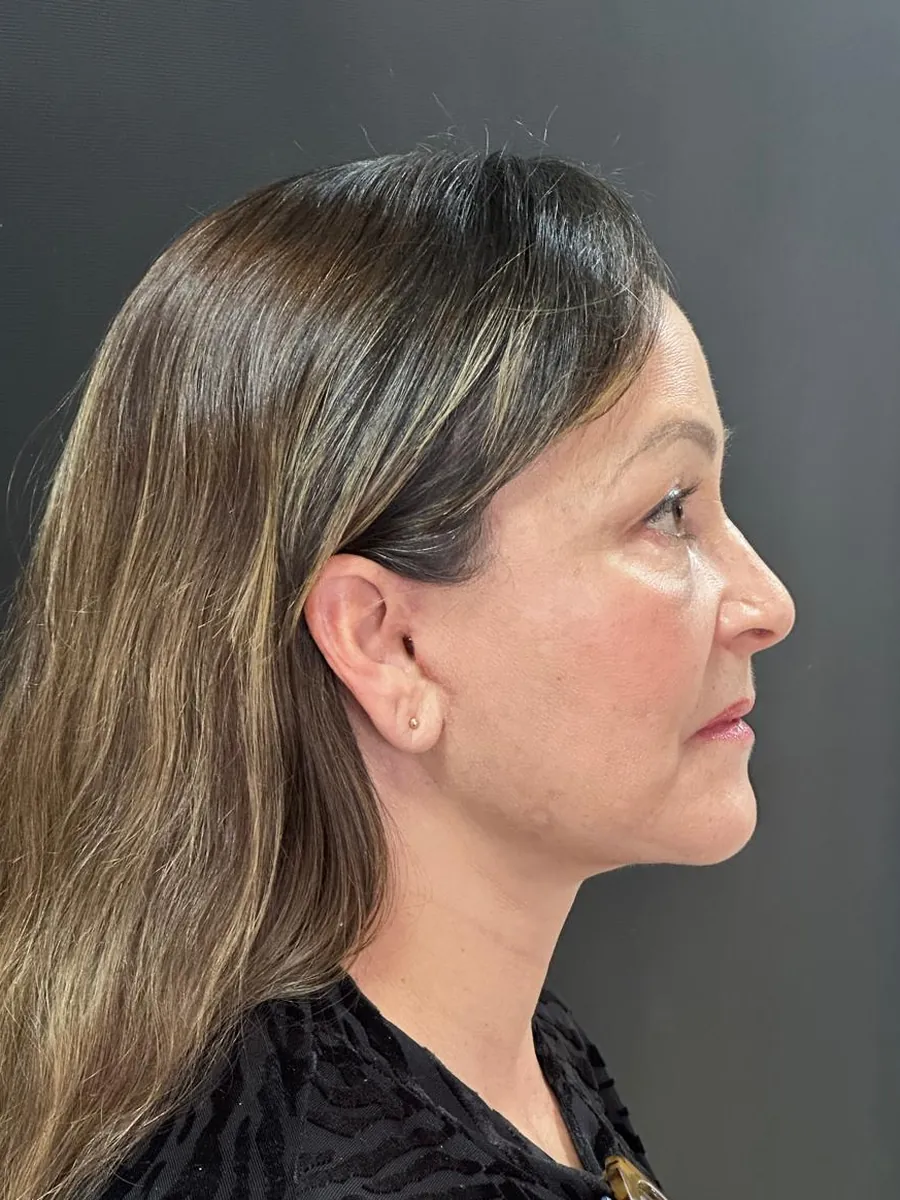 Facelift — Profile — after