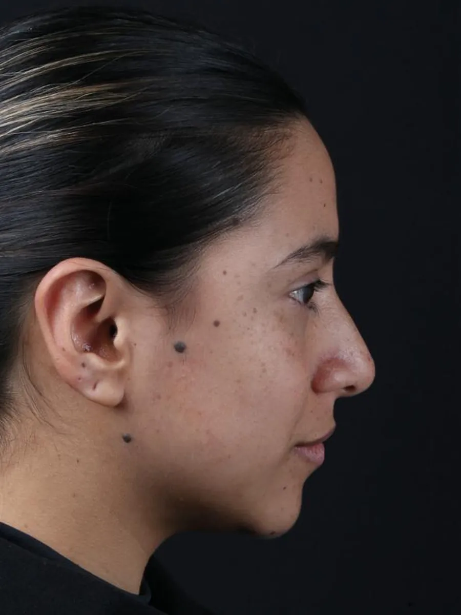Rhinoplasty — Profile — before