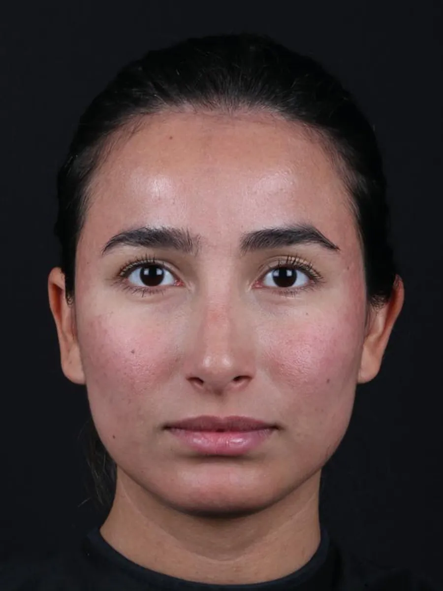 Rhinoplasty — before