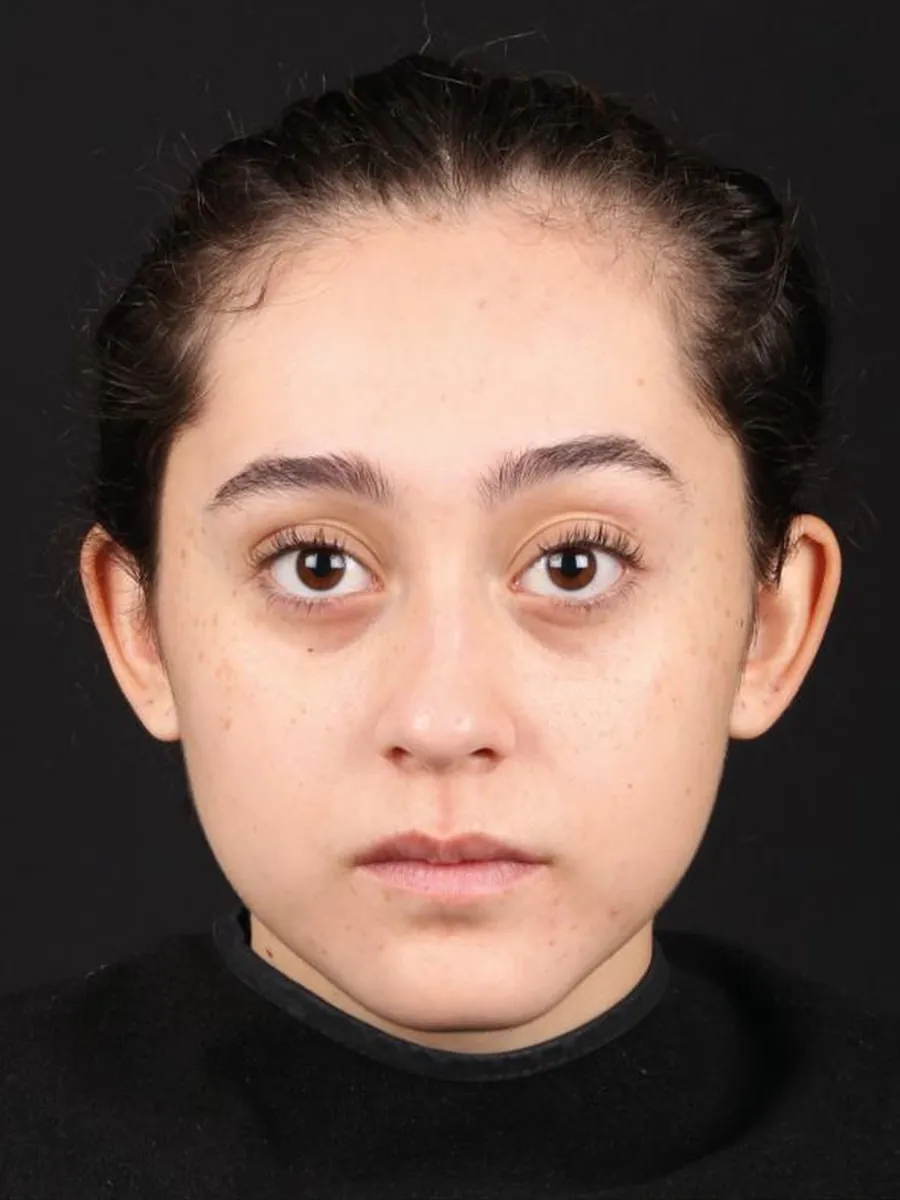Rhinoplasty — before