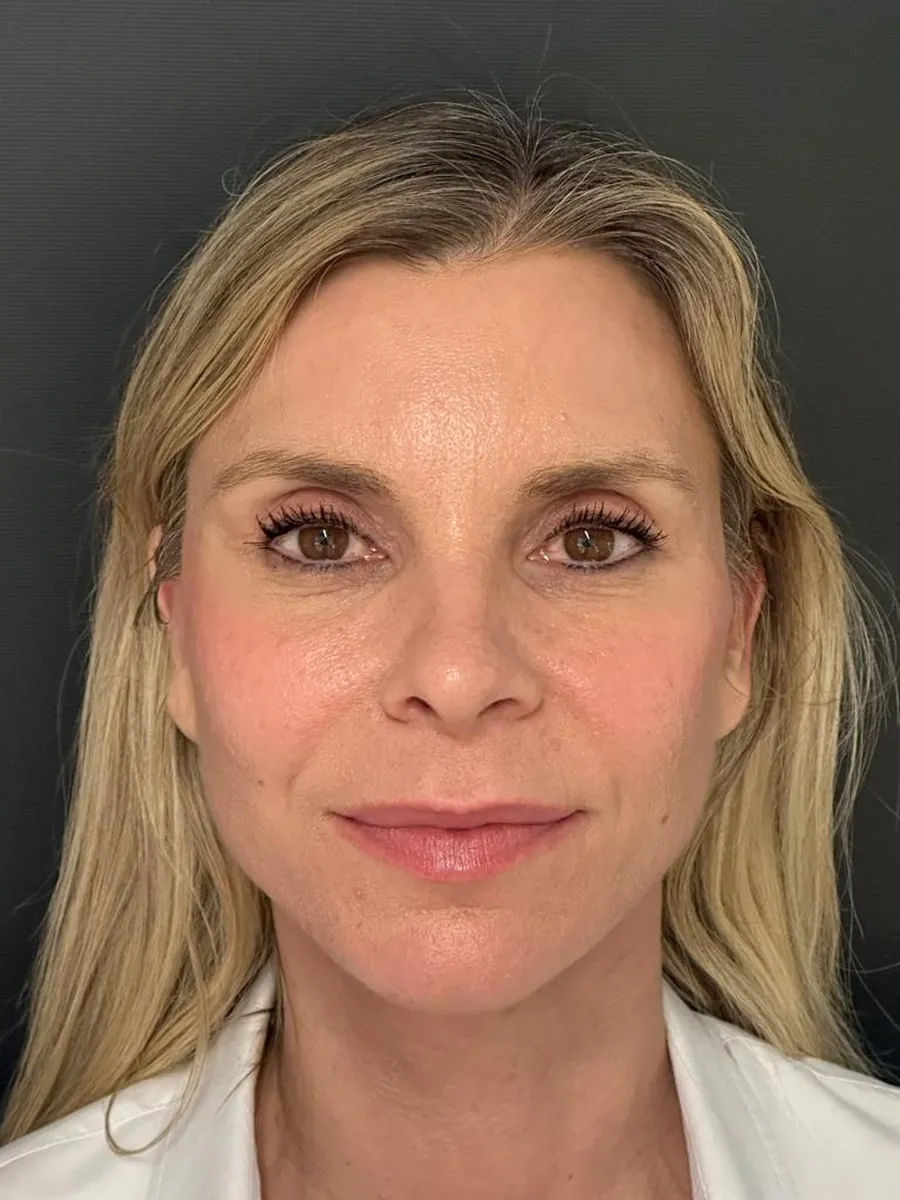 Facelift — after
