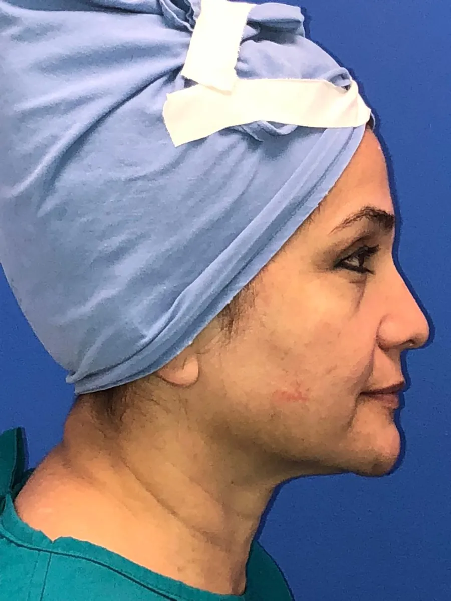 Blepharoplasty — Profile — before