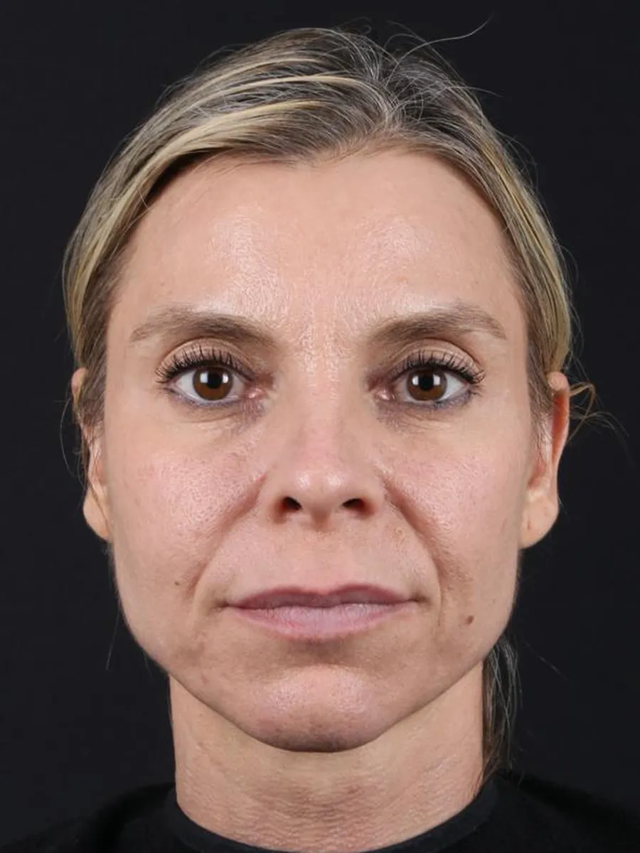 Facelift — before