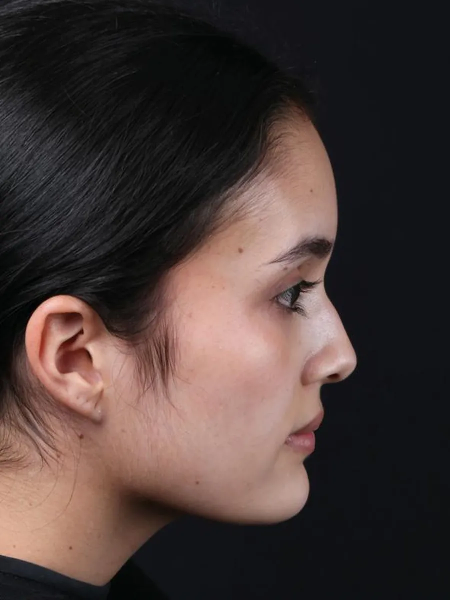 Rhinoplasty — Profile — before