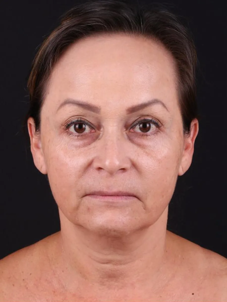 Facelift — before
