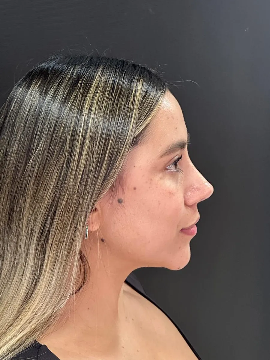 Rhinoplasty — Profile — after