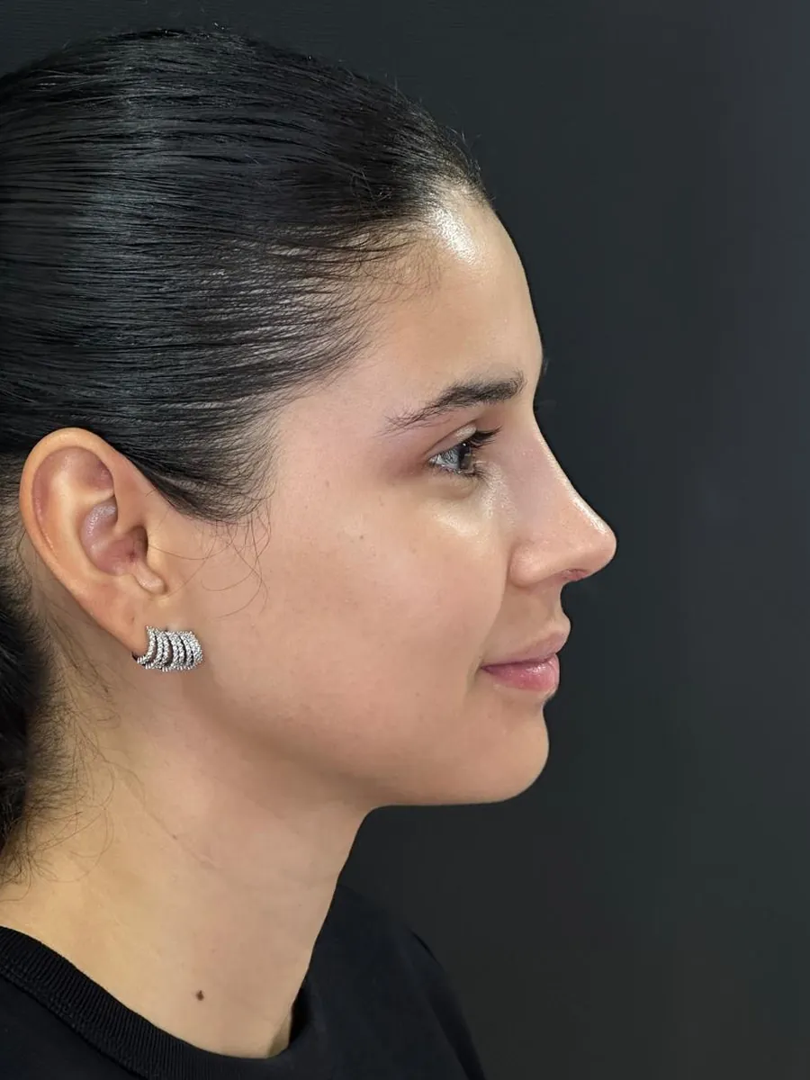 Rhinoplasty — Profile — after