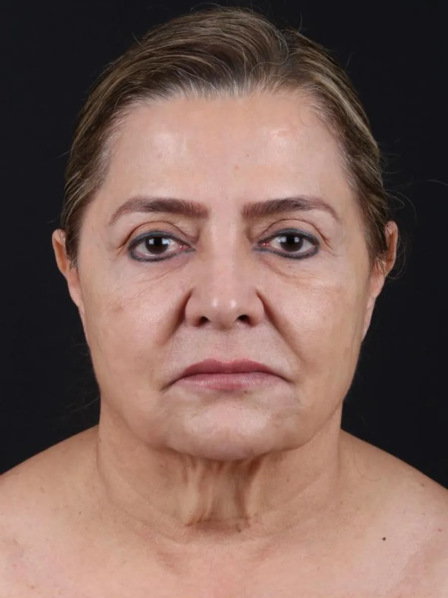 Facelift — before