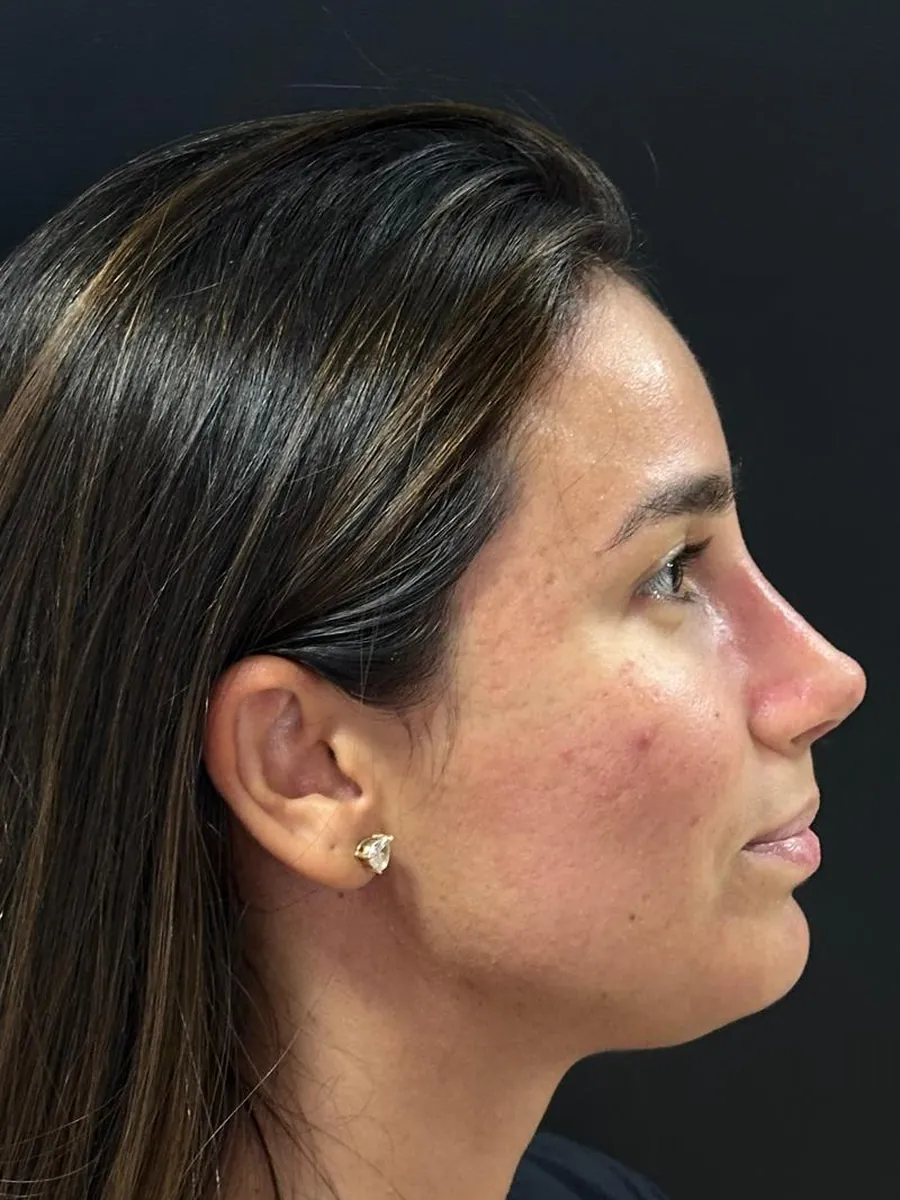 Rhinoplasty — Profile — after