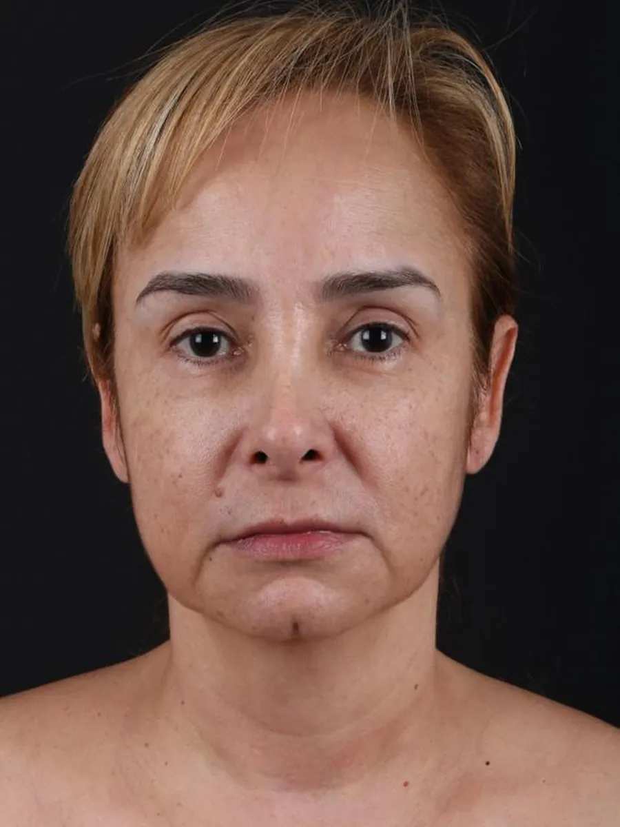 Facelift — before