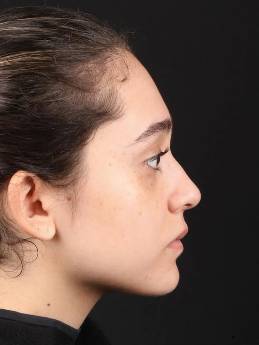 Rhinoplasty — Profile — before