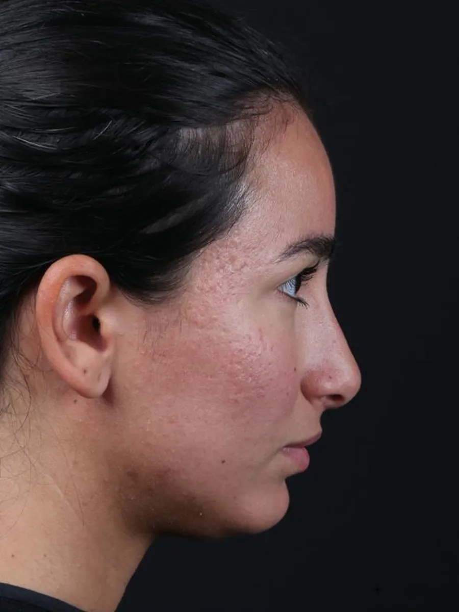 Rhinoplasty — Profile — before