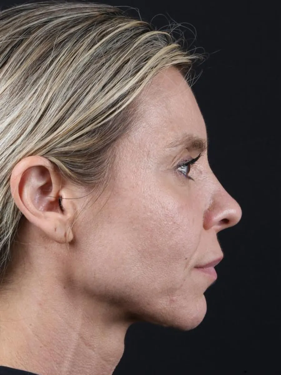 Facelift — Profile — before