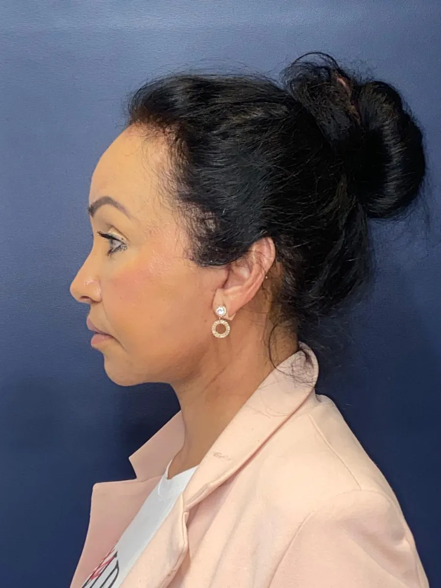 Facelift — Profile — after
