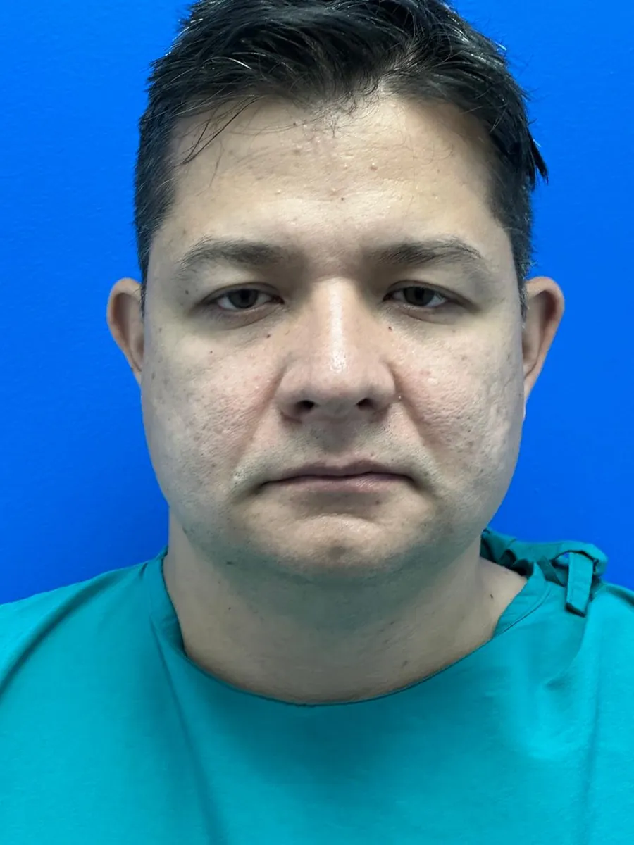 Facial & Neck Liposuction — before