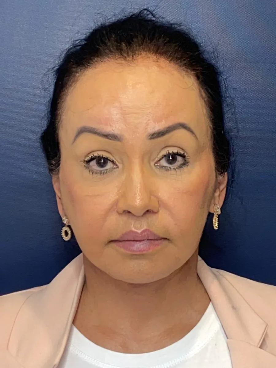Facelift — after