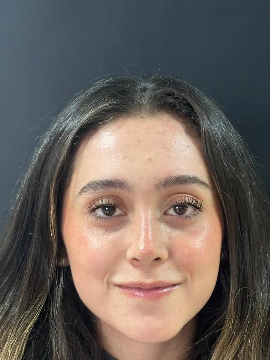 Rhinoplasty — after