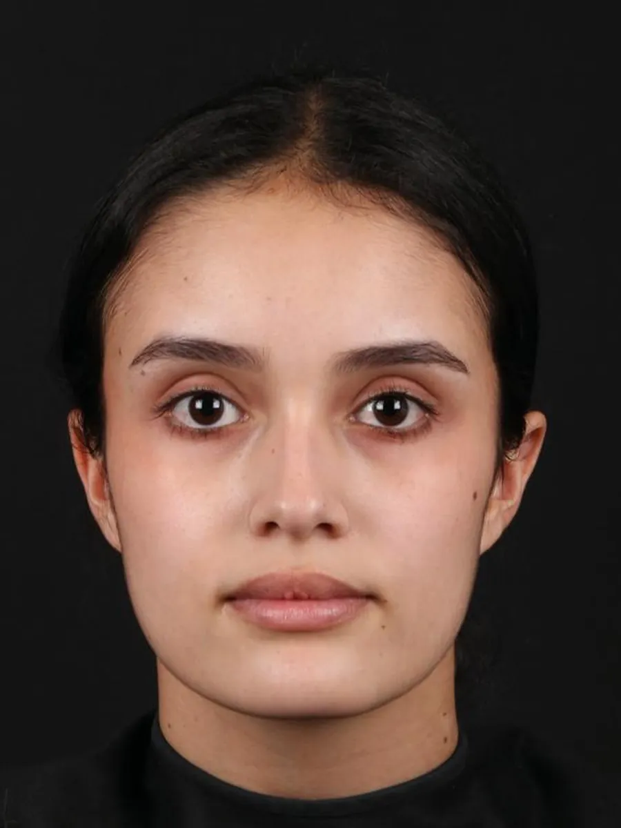 Rhinoplasty — before
