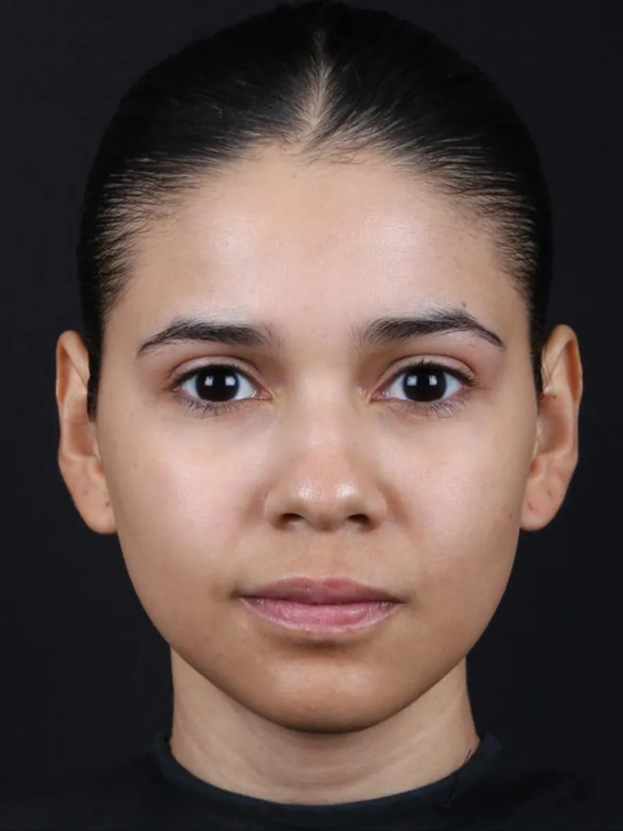 Rhinoplasty — before