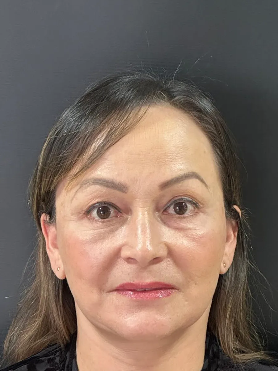 Facelift — after