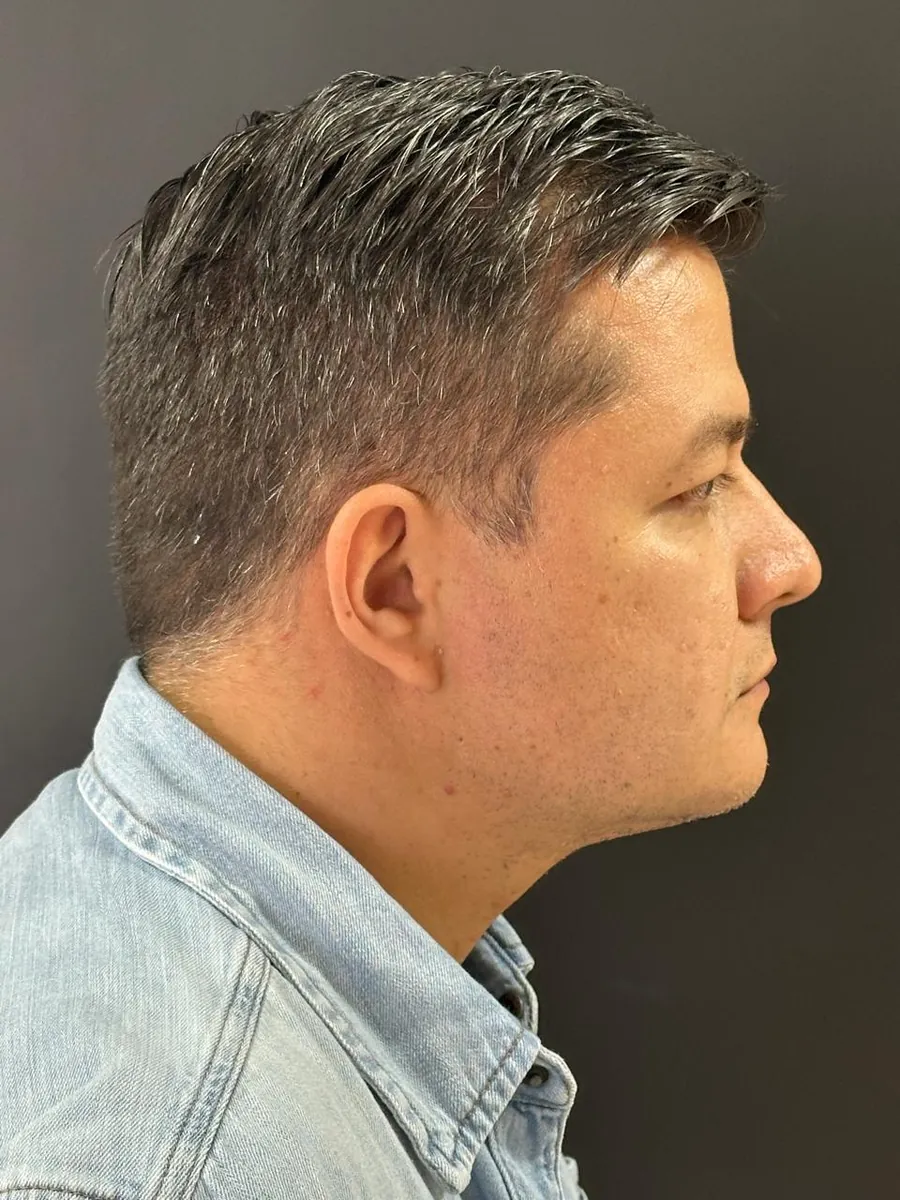 Facial & Neck Liposuction — Profile — after